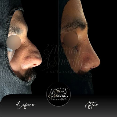 افضل دكتور تجميل الانف في الرياض